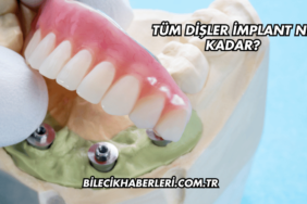 Tüm Dişler İmplant Ne Kadar?
